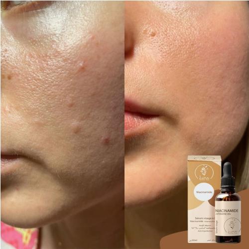 Sérum Niacinamide (Vitamine B3) 7%